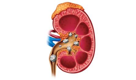 طرق-للوقاية-من-الإصابة-بحصى-الكلى